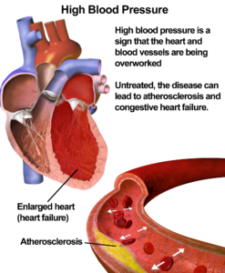 Risks of high blood pressure 247x300 - Risks-of-high-blood-pressure